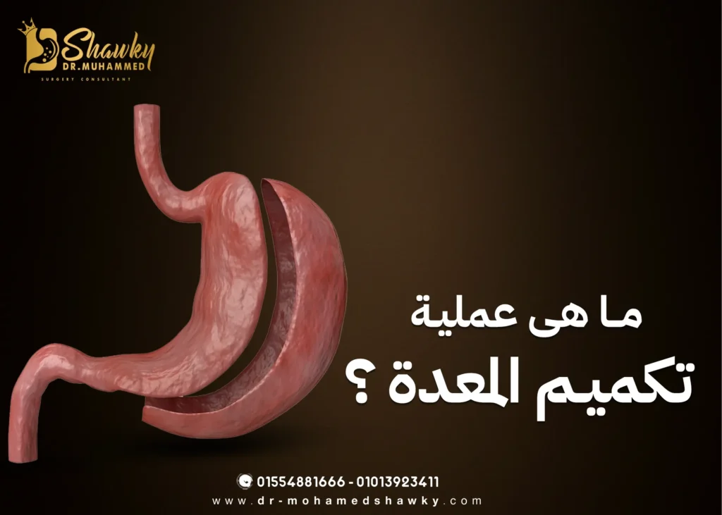 ما هي عملية تكميم المعدة