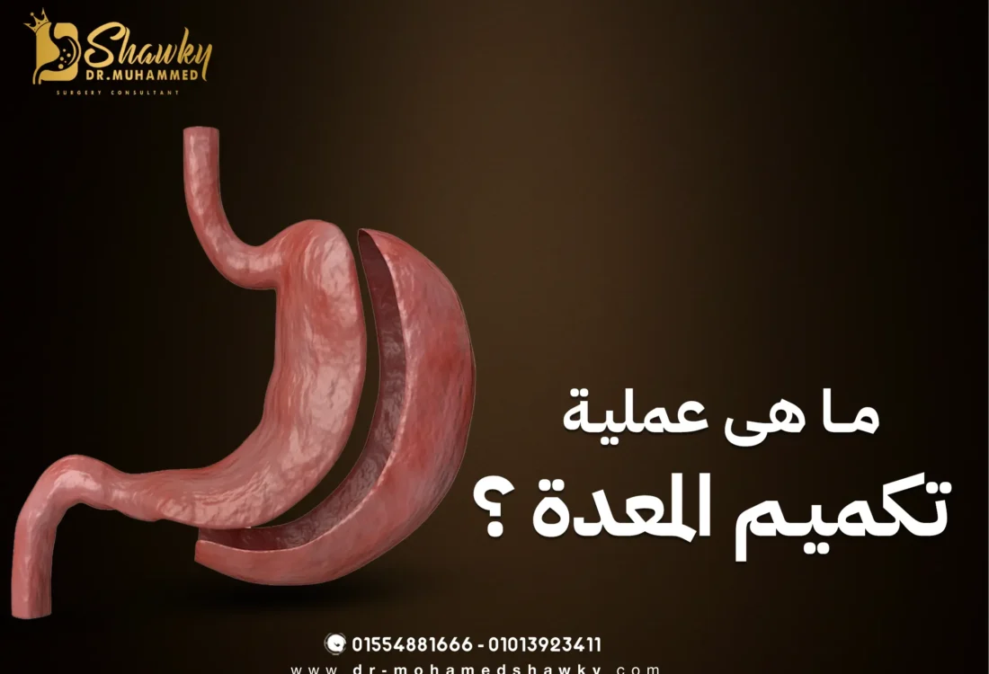ما هي عملية تكميم المعدة